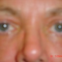 eye area one day post